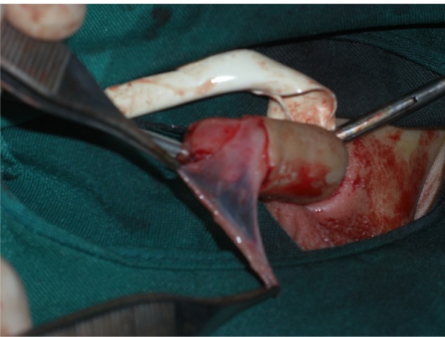 Mathieu repair of distal and midshaft hypospadias: risks and benefits of foreskin reconstruction versus circumcision.