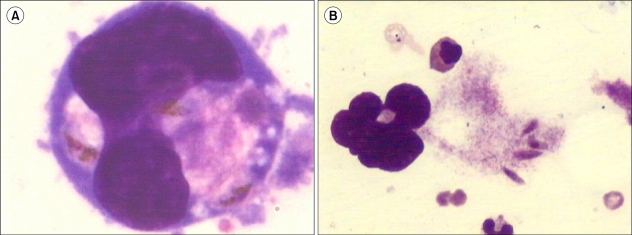 Gametocytes of Plasmodium falciparum in the megakaryocytes.