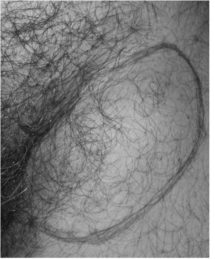 A rare case of inguinal lymph node metastasis from supraglottic laryngeal carcinoma.