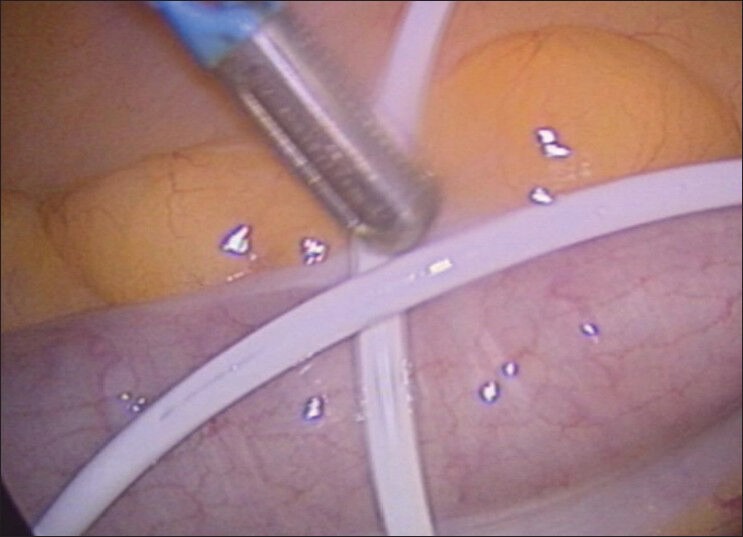 Safety of Laparoscopy in Ventriculoperitoneal Shunt Patients.