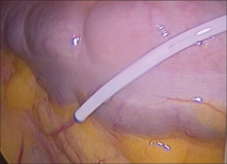 Safety of Laparoscopy in Ventriculoperitoneal Shunt Patients.