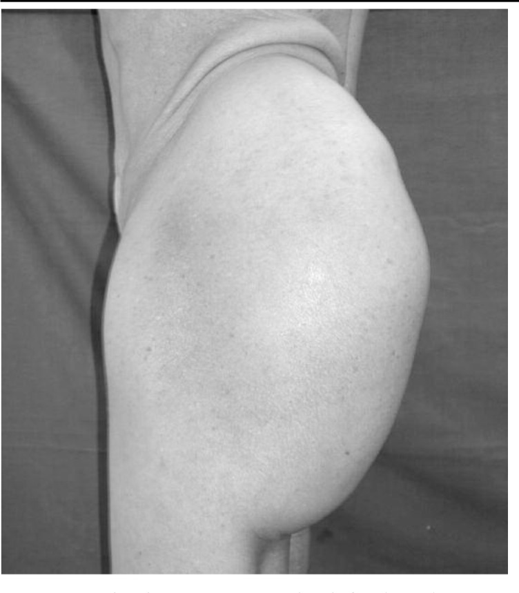 Giant lipoma: a case report.