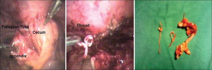Laparoscopic Management of Tubo-Ovarian Stitch Abscess after Tubal Sterilization.