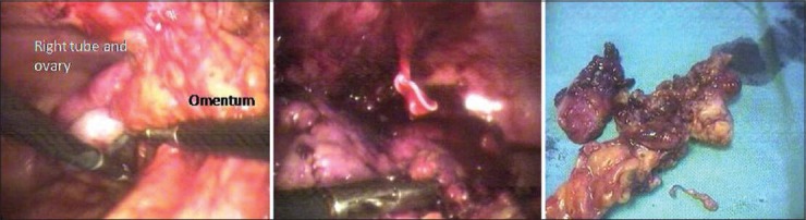 Laparoscopic Management of Tubo-Ovarian Stitch Abscess after Tubal Sterilization.