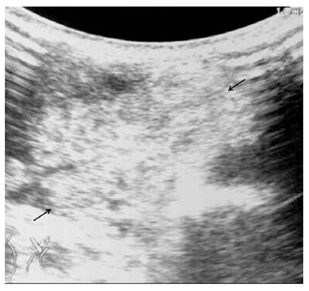 Lymphangioma: Is intralesional bleomycin sclerotherapy effective?