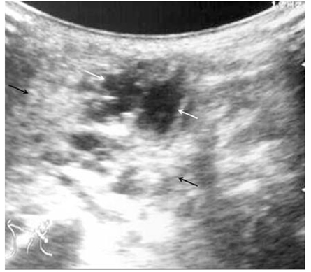 Lymphangioma: Is intralesional bleomycin sclerotherapy effective?