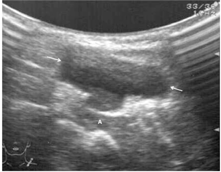 Lymphangioma: Is intralesional bleomycin sclerotherapy effective?