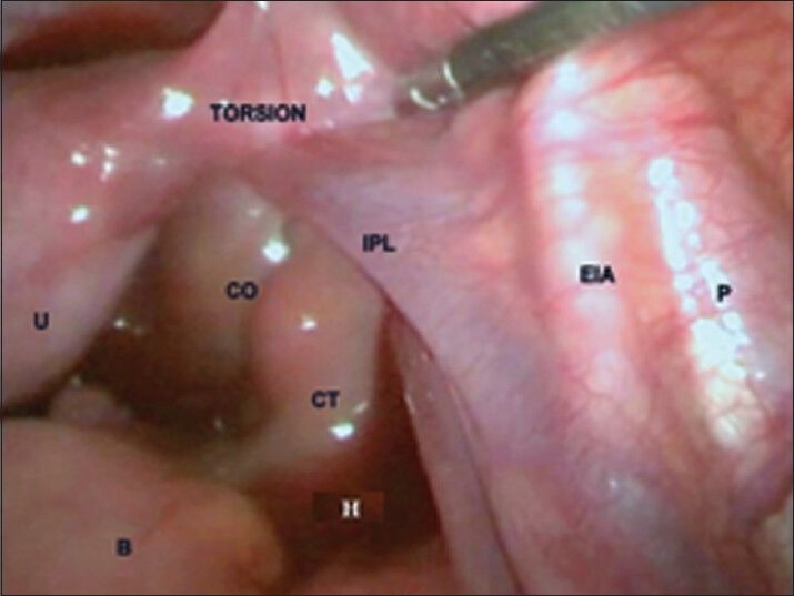 Laparoscopic Management of a Rare Case of Spontaneous Adnexal Torsion in an Adolescent.