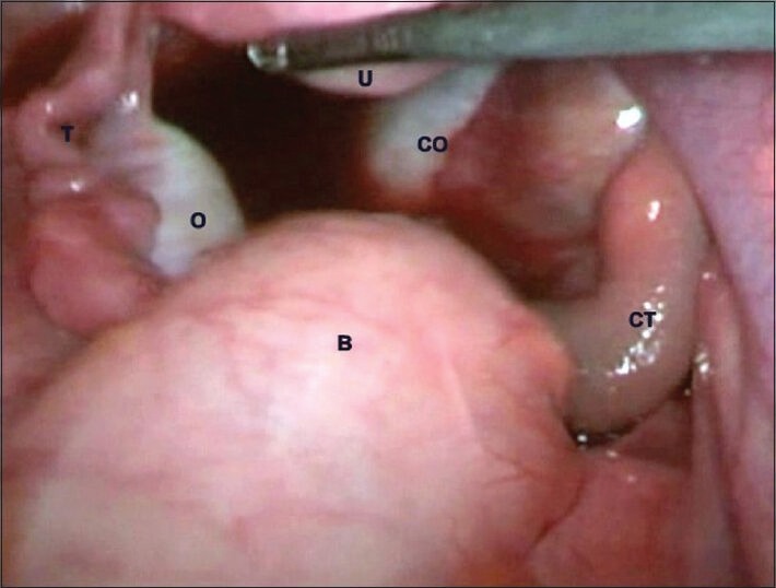 Laparoscopic Management of a Rare Case of Spontaneous Adnexal Torsion in an Adolescent.
