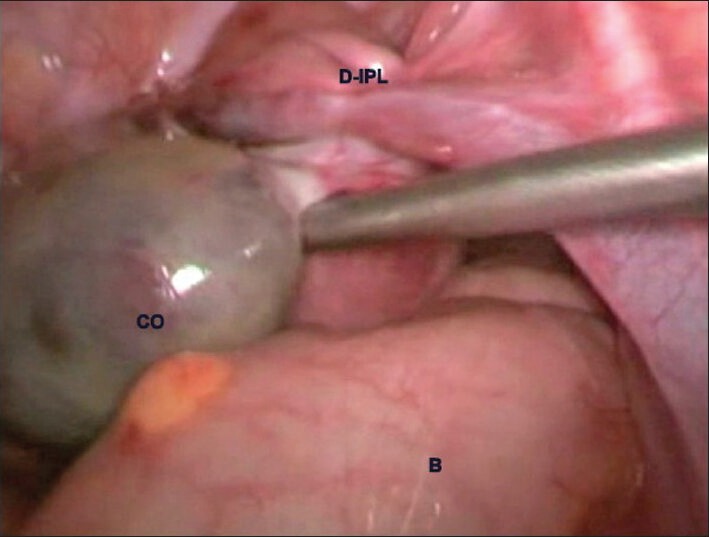 Laparoscopic Management of a Rare Case of Spontaneous Adnexal Torsion in an Adolescent.
