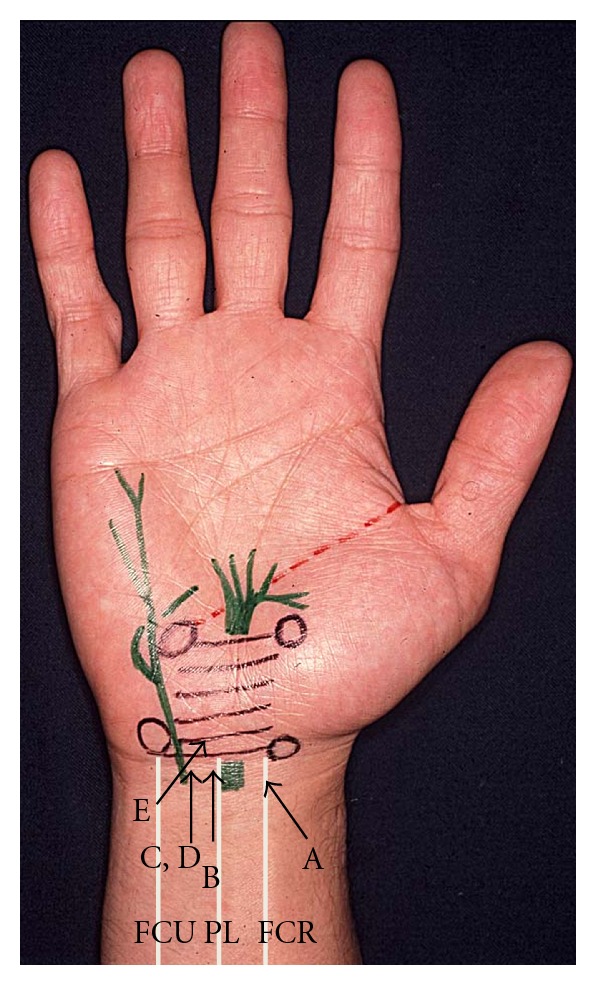 MRI-Based Identification of an Appropriate Point of Needle Insertion for Patients with Idiopathic Carpal Tunnel Syndrome to Avoid Median Nerve Injury.