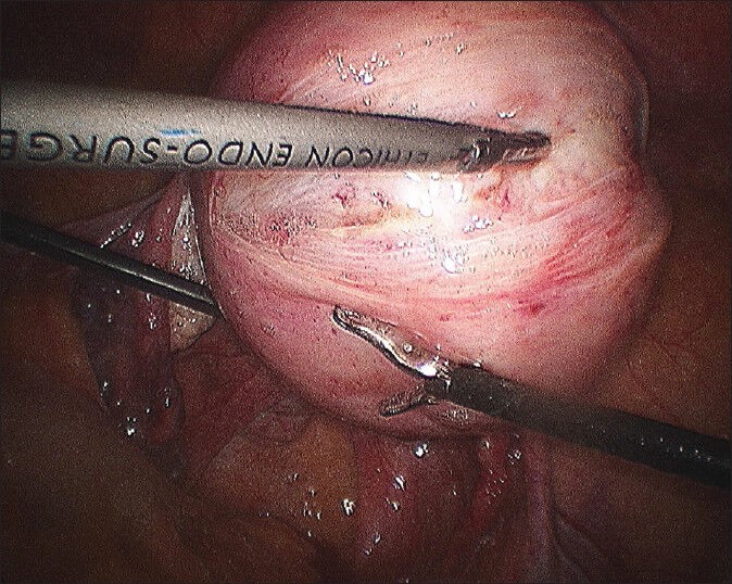 Multiple Layer Closure of Myoma Bed in Laparoscopic Myomectomy.