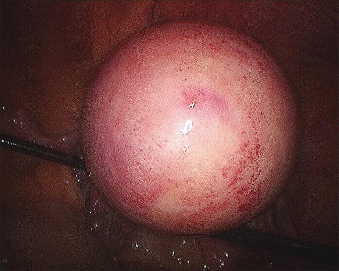 Multiple Layer Closure of Myoma Bed in Laparoscopic Myomectomy.