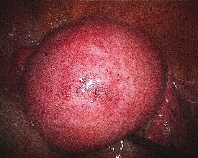 Multiple Layer Closure of Myoma Bed in Laparoscopic Myomectomy.