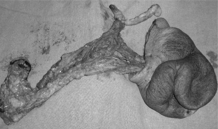 Eviscerated 'amyand' incisional hernia.