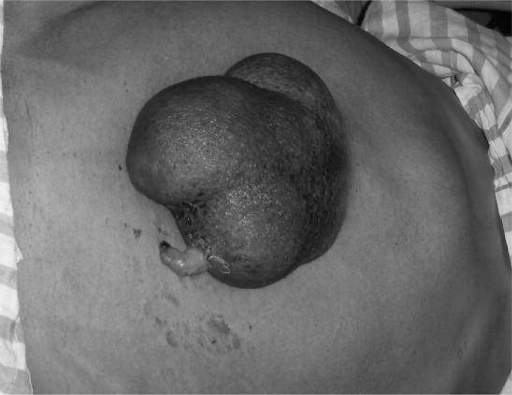 Eviscerated 'amyand' incisional hernia.