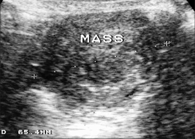 Laparoscopic Resection of Unruptured Rudimentary Horn Pregnancy.