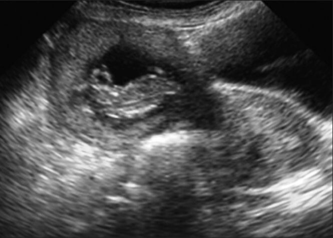 Laparoscopic Resection of Unruptured Rudimentary Horn Pregnancy.