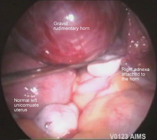 Laparoscopic Resection of Unruptured Rudimentary Horn Pregnancy.