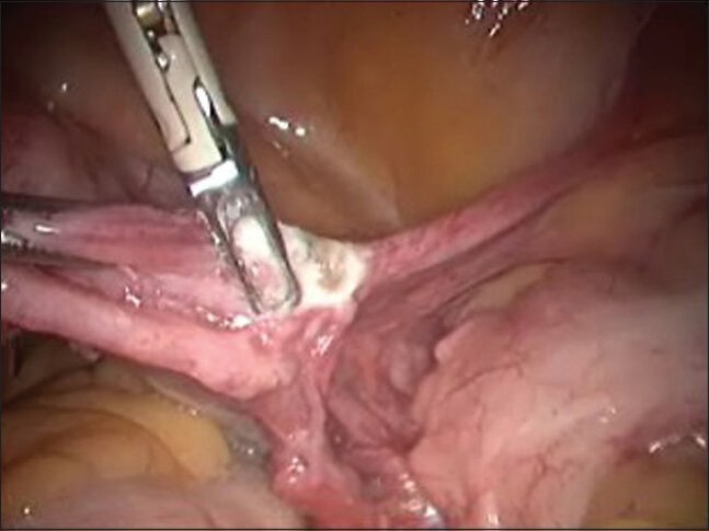 Rare Case of Ovarian Cystic Lymphangioma Managed at Laparoscopy.