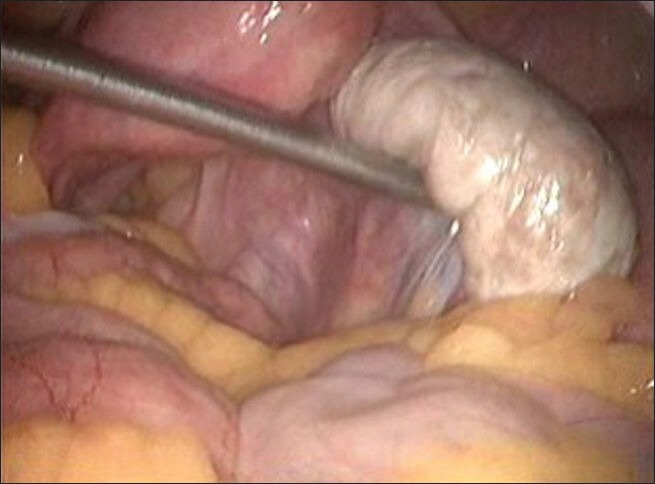 Rare Case of Ovarian Cystic Lymphangioma Managed at Laparoscopy.
