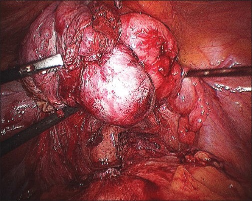 Laparoscopic Management of Congenital Cervico-Vaginal Agenesis.
