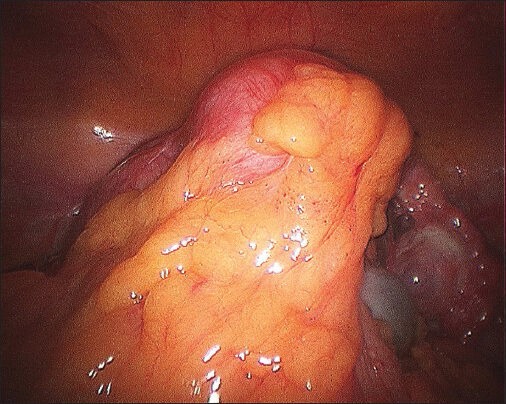 Laparoscopic Management of Congenital Cervico-Vaginal Agenesis.