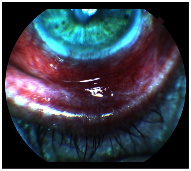 Central corneal melting associated with reformulated generic diclofenac in a patient with inferior fornix foreshortening.