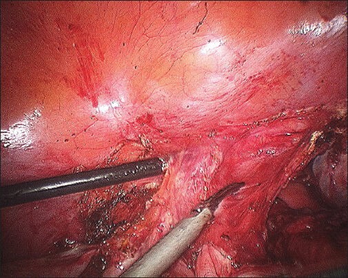 Laparoscopic Management of Congenital Cervico-Vaginal Agenesis.