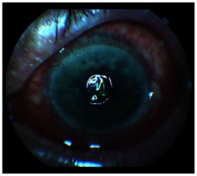 Central corneal melting associated with reformulated generic diclofenac in a patient with inferior fornix foreshortening.