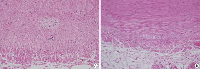 Surgical outcomes after total colectomy with ileorectal anastomosis in patients with medically intractable slow transit constipation.