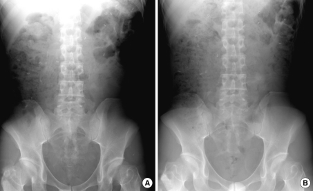 Surgical outcomes after total colectomy with ileorectal anastomosis in patients with medically intractable slow transit constipation.