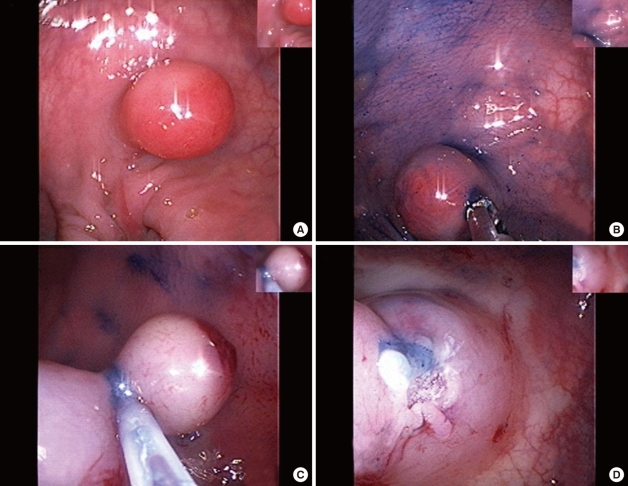 A case of endoscopic resection of a colonic semipedunculated leiomyoma.