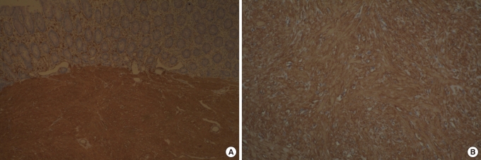 A case of endoscopic resection of a colonic semipedunculated leiomyoma.