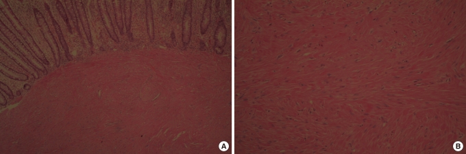 A case of endoscopic resection of a colonic semipedunculated leiomyoma.