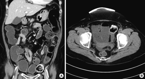 A case of successful colonoscopic treatment of colonic obstruction caused by phytobezoar.