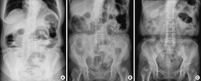 A case of successful colonoscopic treatment of colonic obstruction caused by phytobezoar.