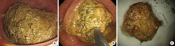 A case of successful colonoscopic treatment of colonic obstruction caused by phytobezoar.