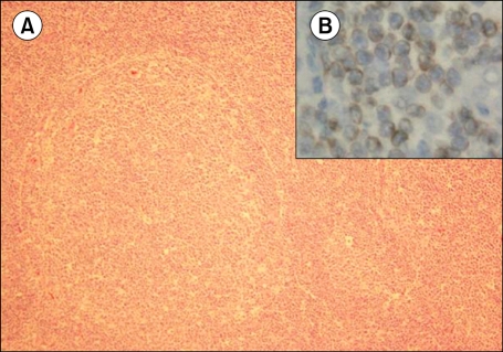 A case of follicular B-cell lymphoma treated using clarithromycin.