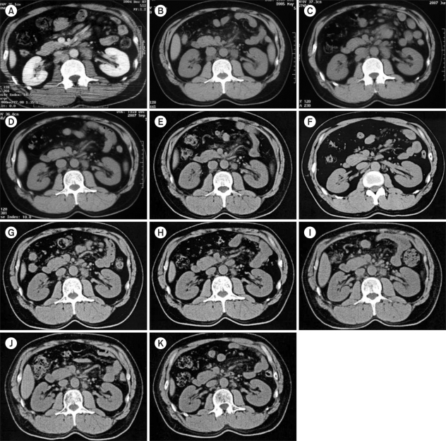 A case of follicular B-cell lymphoma treated using clarithromycin.