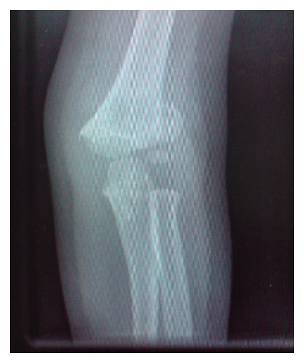 Lateral entry fixation using three divergent pins for displaced paediatric supracondylar humeral fractures.