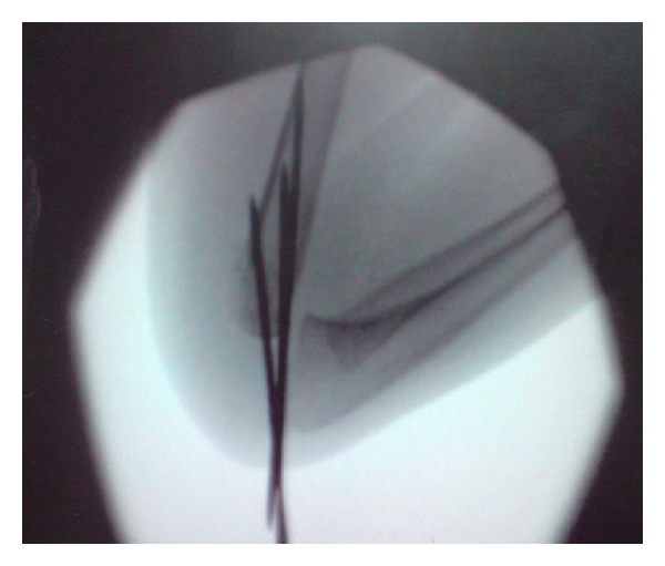 Lateral entry fixation using three divergent pins for displaced paediatric supracondylar humeral fractures.