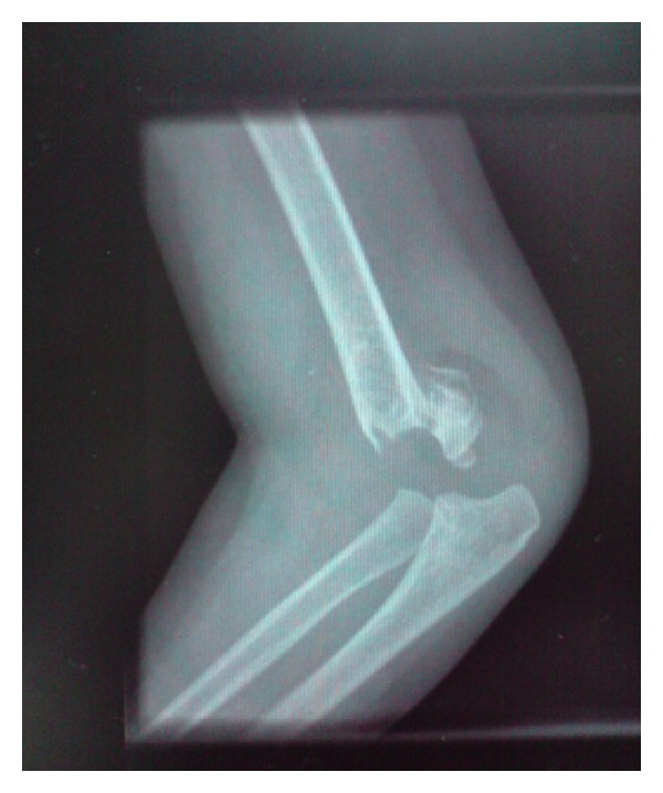 Lateral entry fixation using three divergent pins for displaced paediatric supracondylar humeral fractures.