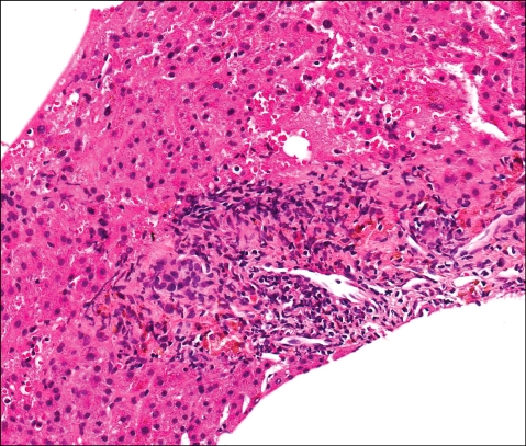 Clinical significance of anti-mitochondrial antibodies in a patient with chronic graft-versus-host disease following hematopoietic stem cell transplantation.