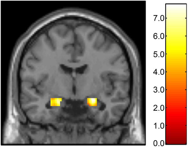 Medial prefrontal cortex serotonin 1A and 2A receptor binding interacts to predict threat-related amygdala reactivity.