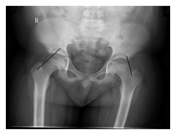 The epidemiology and demographics of slipped capital femoral epiphysis.