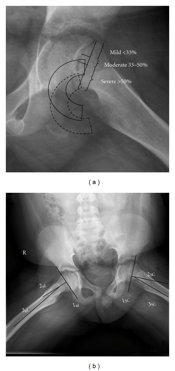 The epidemiology and demographics of slipped capital femoral epiphysis.