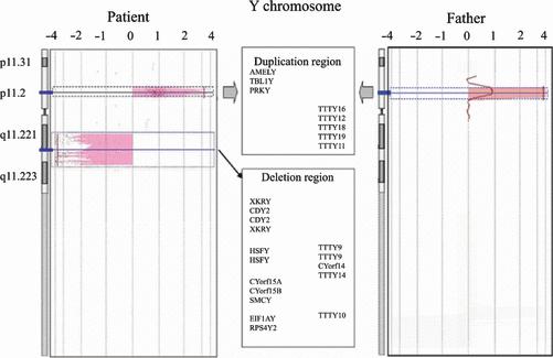 A rare Y chromosome constitutional rearrangement: a partial AZFb deletion and duplication within chromosome Yp in an infertile man with severe oligoasthenoteratozoospermia