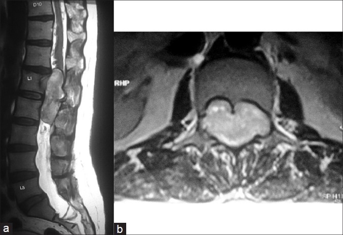 Functional Paraganglioma: A Rare Conus-cauda Lesion.