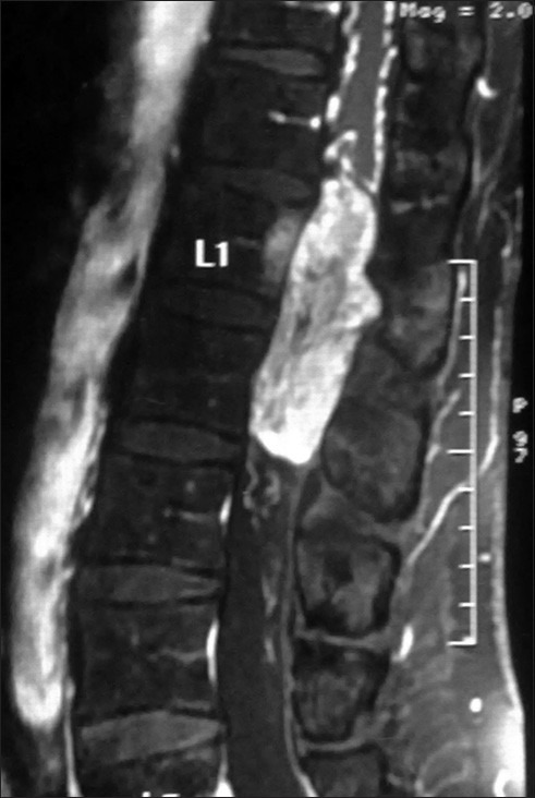 Functional Paraganglioma: A Rare Conus-cauda Lesion.